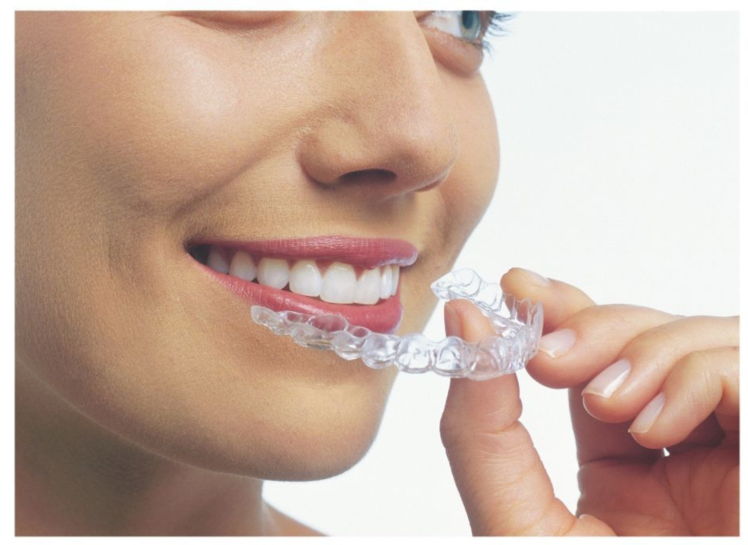 Detailed invisalign aligner